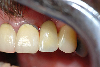after implant example 2