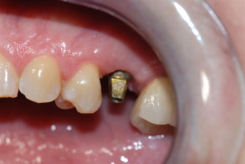 before implant example 4